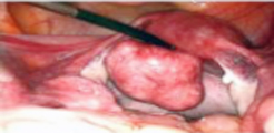 Fibroid