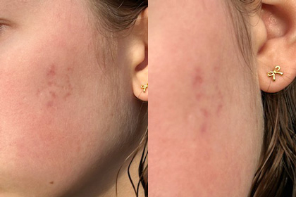 acne skinpen A