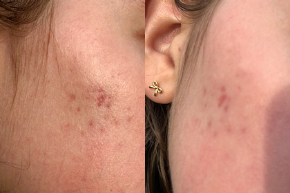 acne skinpen B