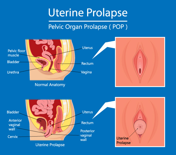 Prolapsed Bladder Surgery