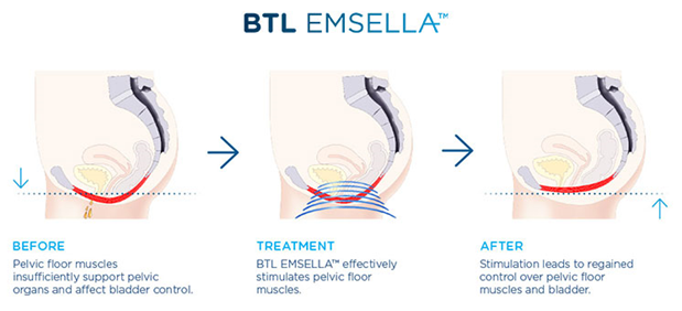 BTL Emsella