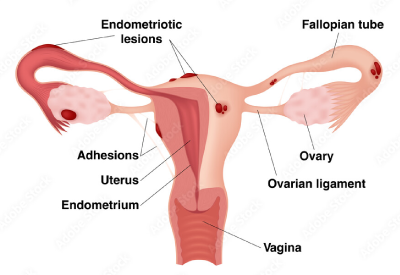 Endometriosis