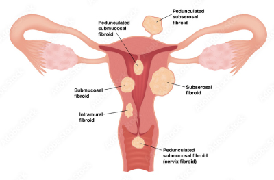 Fibroids